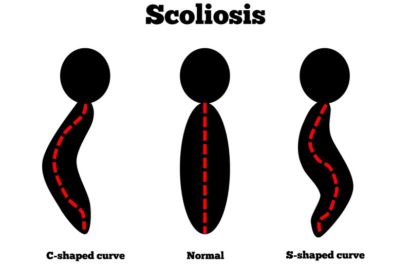 Algonac, MI scoliosis treatment